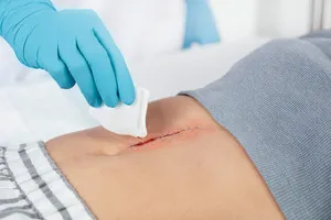 Leukoplast compress cotton gauze steril, Röko